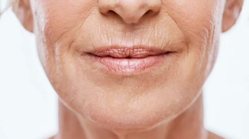 How To Treat Marionette Lines: A Complete Guide